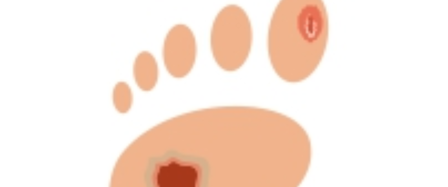 Diabetes and Feet – Diabetic Foot Ulcer